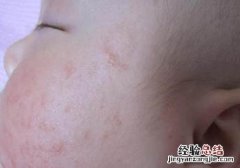 新生儿得痤疮怎么治疗 新生儿痤疮怎么治疗