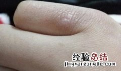 冻疮怎么治 冻疮如何治