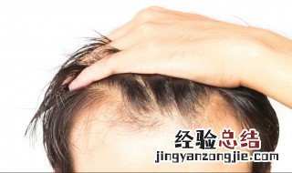 怎样防止掉头发的小妙招 怎样防止掉头发