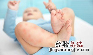 夏季驱蚊防蚊小妙招 夏季驱蚊的小妙招有哪些