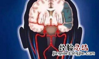 脑部腔梗是什么意思 腔梗是什么意思