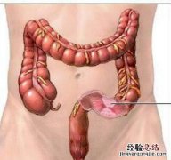 直肠炎的症状及治疗 溃疡性直肠炎的症状及治疗