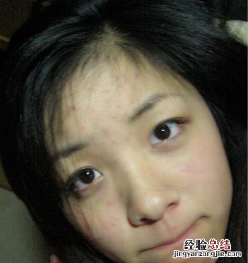 痤疮治疗 痤疮有哪些治疗方法