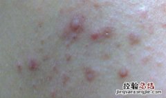 脸上的痤疮怎么去除 脸上的痤疮怎么去除小妙招