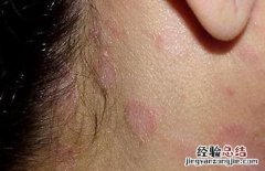 接触性皮炎传染吗 接触性皮炎有传染性吗
