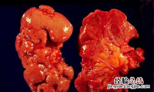 肾炎的治疗方法 系统性红斑狼疮性肾炎的治疗方法