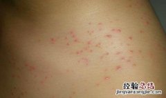 猩红热传染吗?严重吗 猩红热传染吗