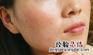 天气热脸上长痘痘怎么回事儿 天气热脸上长痘痘怎么回事
