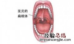 扁桃体发炎怎么办最简单的方法 扁桃体发炎可以尝试这样做
