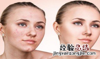 鬓角老是出痘是怎么回事 鬓角容易长痘是什么情况