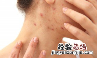 痘痘破了怎么处理 红肿痘痘破了怎么处理