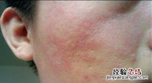 脂溢性皮炎传染吗 脂溢性皮炎传染吗?