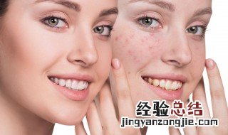 怎样消除红肿的痘痘 怎样消除红肿的痘痘最有效