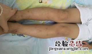 如何矫正x型腿幼儿 小孩儿x型腿怎么矫正