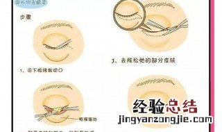如何去除眼袋的方法图片 如何去除眼袋的方法