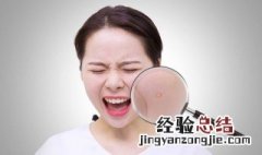 姨妈期长痘痘怎么调理 生理期长痘痘怎么调理