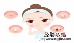 痤疮和痘痘有什么区别 痘痘和痤疮有啥区别