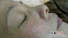 激光去除老年斑 激光去除老年斑多少钱