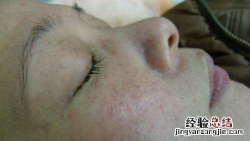 激光去除老年斑 激光去除老年斑多少钱