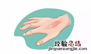 被热水烫红了怎么处理 被热水烫红了怎么处理图片