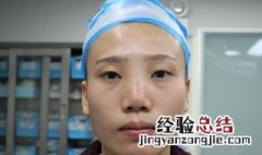 内双用窄的还是宽的双眼皮贴 内双用窄的还是宽的双眼皮贴效果好