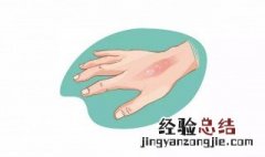 被热水烫到怎么办 喝水被热水烫到怎么办