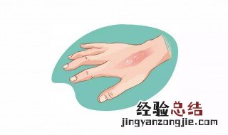 被热水烫到怎么办 喝水被热水烫到怎么办