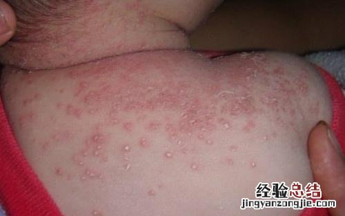 怎么治疗湿疹 湿疹怎么治疗能除根
