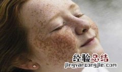 黄褐斑和老年斑的区别 黄褐斑和老年斑的区别图