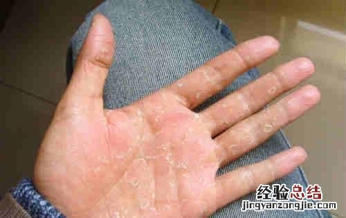 季节性手脱皮 季节性手脱皮是缺什么维生素