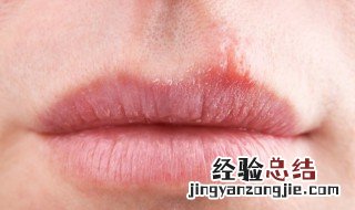 如何防止冬季嘴唇干裂 冬天嘴唇容易干裂怎么办