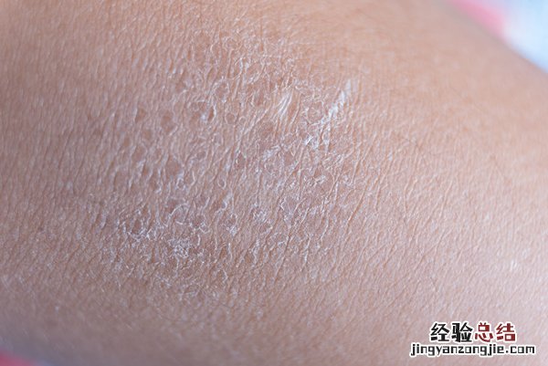 冬季皮肤干燥怎么办 冬季皮肤干燥怎么缓解