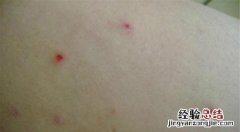 儿童阴囊疥疮结节怎么治疗 疥疮结节怎么治疗
