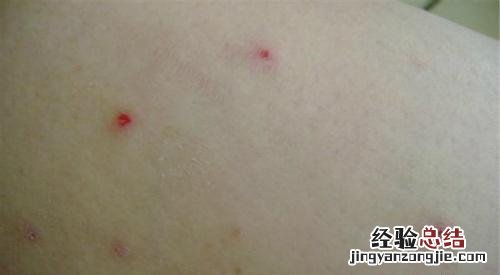 儿童阴囊疥疮结节怎么治疗 疥疮结节怎么治疗