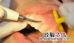 拔牙后多久可以刷牙 现在就告诉大家