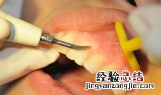 拔牙后多久可以刷牙 现在就告诉大家