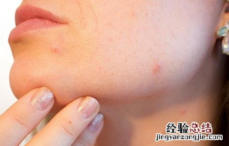 皮肤过敏注意事项饮食禁忌 皮肤过敏者的饮食禁忌