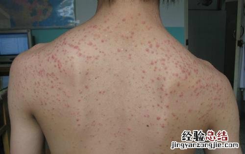 毛囊炎是怎么引起的？ 毛囊炎是怎么引起的原因
