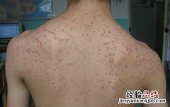 毛囊炎是怎么引起的？ 毛囊炎是怎么引起的原因