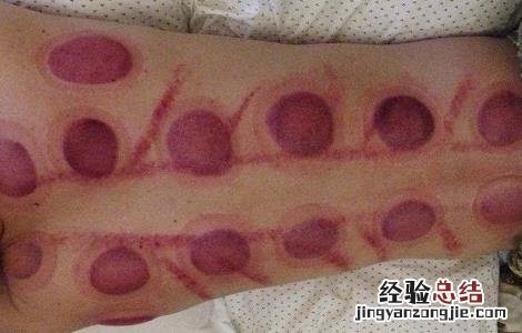 拔火罐的注意事项和禁忌有哪些 拔火罐的注意事项和禁忌