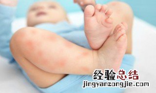 嘴巴痱子怎么消除 痱子怎么消除