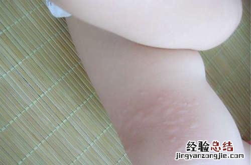 皮肤过敏发红怎么办家庭治疗 皮肤过敏发红怎么办