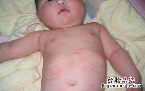 寒冷性荨麻疹的治疗方法 寒冷性荨麻疹的有效治疗方法