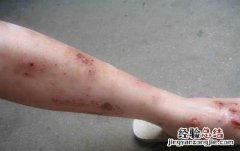过敏性皮炎怎么治能除根 过敏性皮炎怎么治