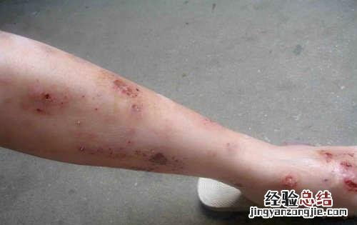 过敏性皮炎怎么治能除根 过敏性皮炎怎么治
