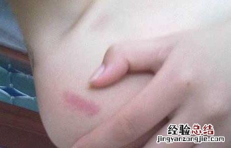 种草莓有什么危害 身上种草莓有什么危害