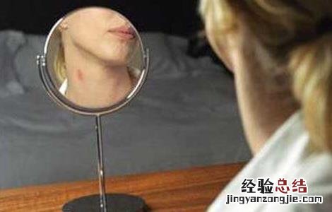 种草莓怎么快速消除 胸上被种草莓怎么快速消除