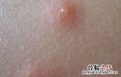 被臭虫咬了怎么办 被臭虫咬了怎么办怎么止痒