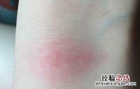 被跳蚤咬了怎么止痒什么药最好 广西 被跳蚤咬了怎么止痒
