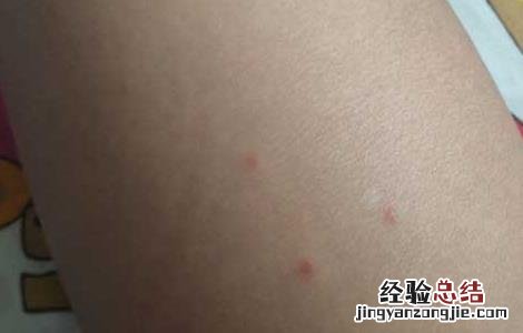 被跳蚤咬了怎么止痒什么药最好 广西 被跳蚤咬了怎么止痒